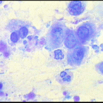 Ομαδα αδενικών κυττάρων με διογκωμένους υπερχρωματικούς πυρήνες. 